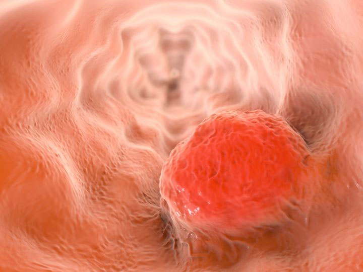 Illustration of Esophageal Cancer