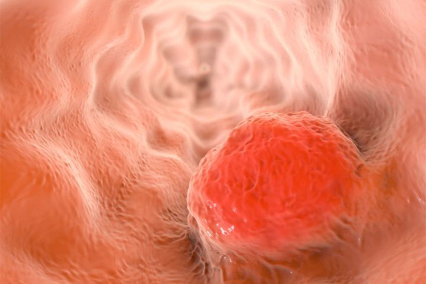 New Insights into Biology, Origin of Deadly Stomach and Esophageal Cancers